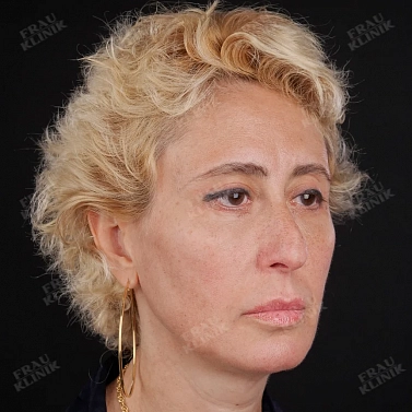 Пластика век