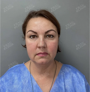 Фейслифтинг