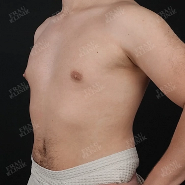 Мастэктомия