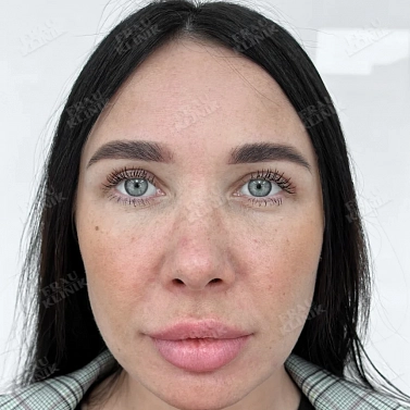 Пластика век