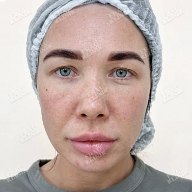 Пластика век