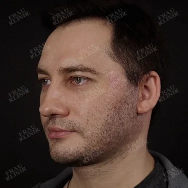 Фейслифтинг