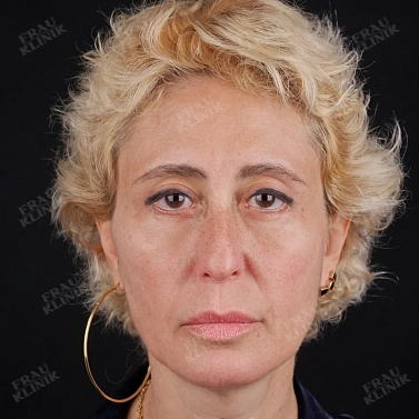 Пластика век