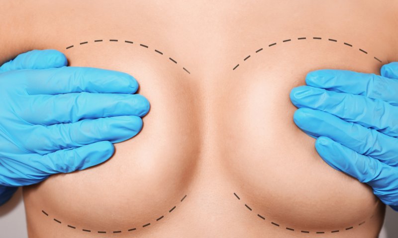 Как ставить имплант: под грудью, через ареолу или через подмышечную впадину? Мнение эксперта