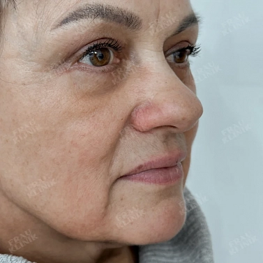 Пластика век