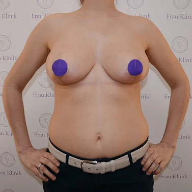 Уменьшение груди