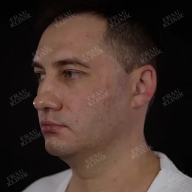 Фейслифтинг