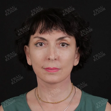 Фейслифтинг и блефаропластика