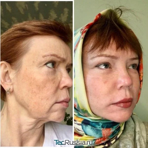 deep-smas-svetlana-7.webp deep-smas-svetlana-7.webp