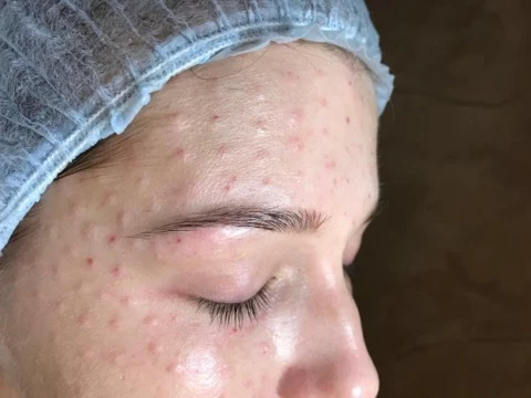 Папулы - уплотнения после процедур мезотерапии и биоревитализации