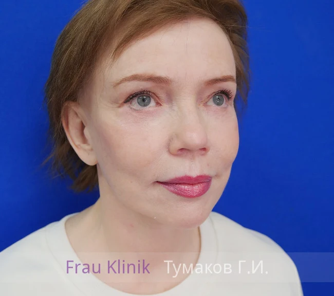 deep-smas-svetlana-17.webp deep-smas-svetlana-17.webp