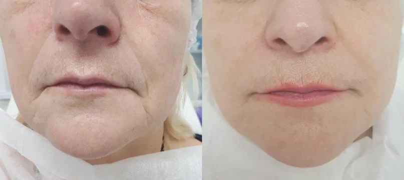 Результат моделирования лица при помощи филлеров на основе гиалуроновой кислоты