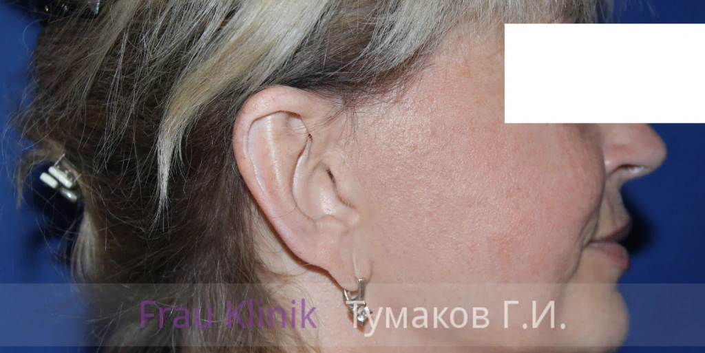 facelift_rubtsi-1.webp facelift_rubtsi-1.webp