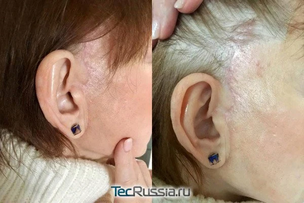 deep-smas-svetlana-5.webp deep-smas-svetlana-5.webp