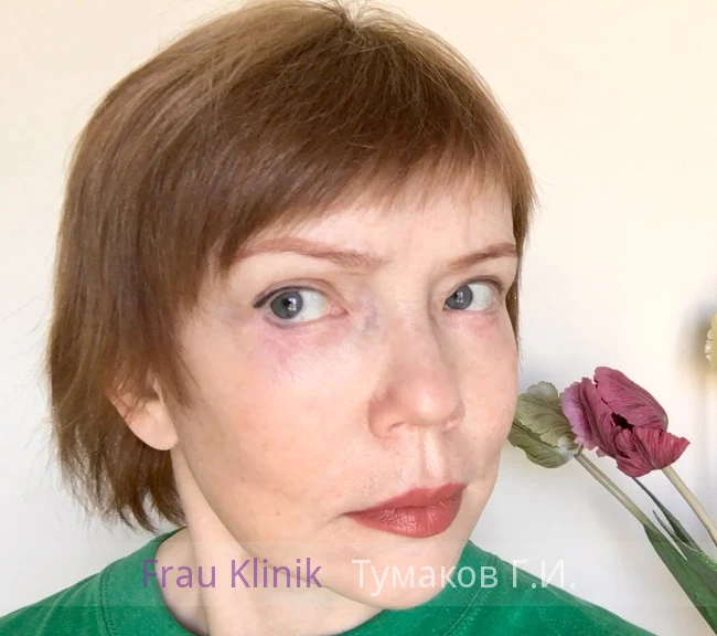 deep-smas-svetlana-11.webp deep-smas-svetlana-11.webp