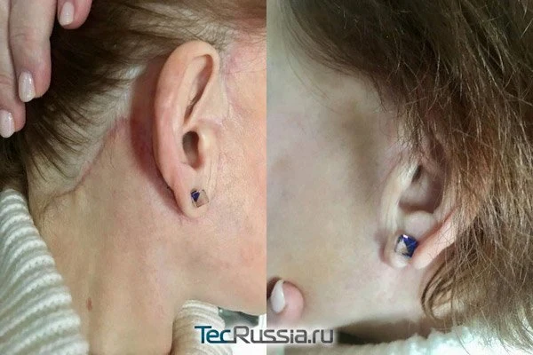 deep-smas-svetlana-6.webp deep-smas-svetlana-6.webp