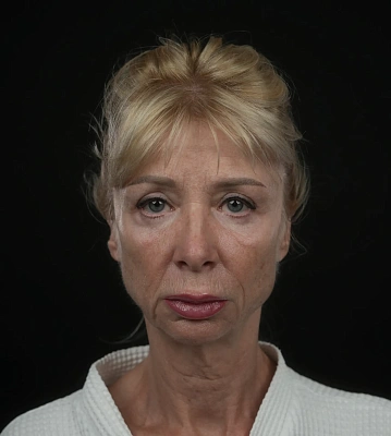 Фейслифтинг + Височный лифтинг