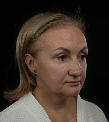 Фейслифтинг