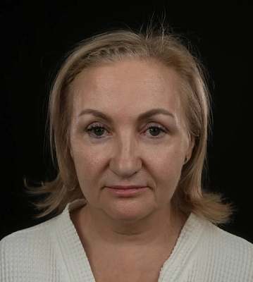 Фейслифтинг