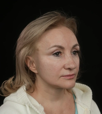 Фейслифтинг