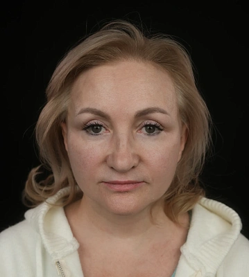 Фейслифтинг