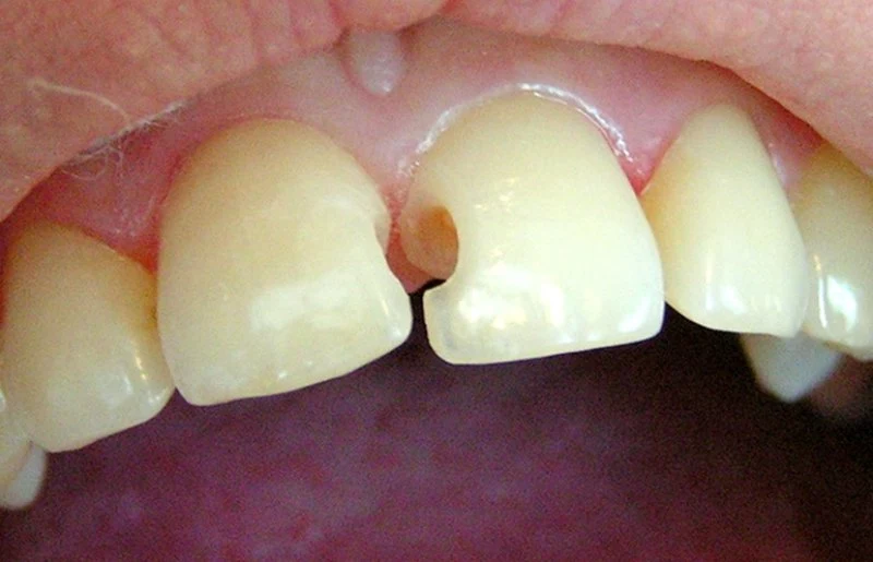 Как сохранить передние молочные зубы