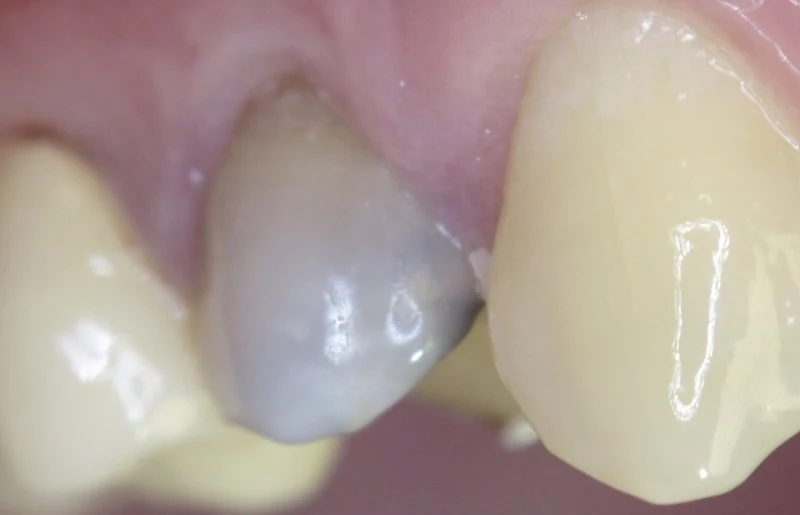 Потемнел зуб под коронкой. Как лечить черные зубы? | Альянс бьюти-ортопедов, Москва